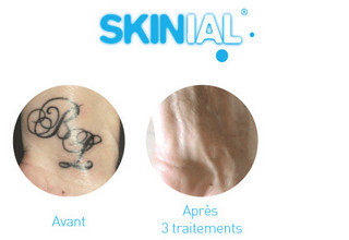 « Skinial propose une solution inédite en matière de détatouage »